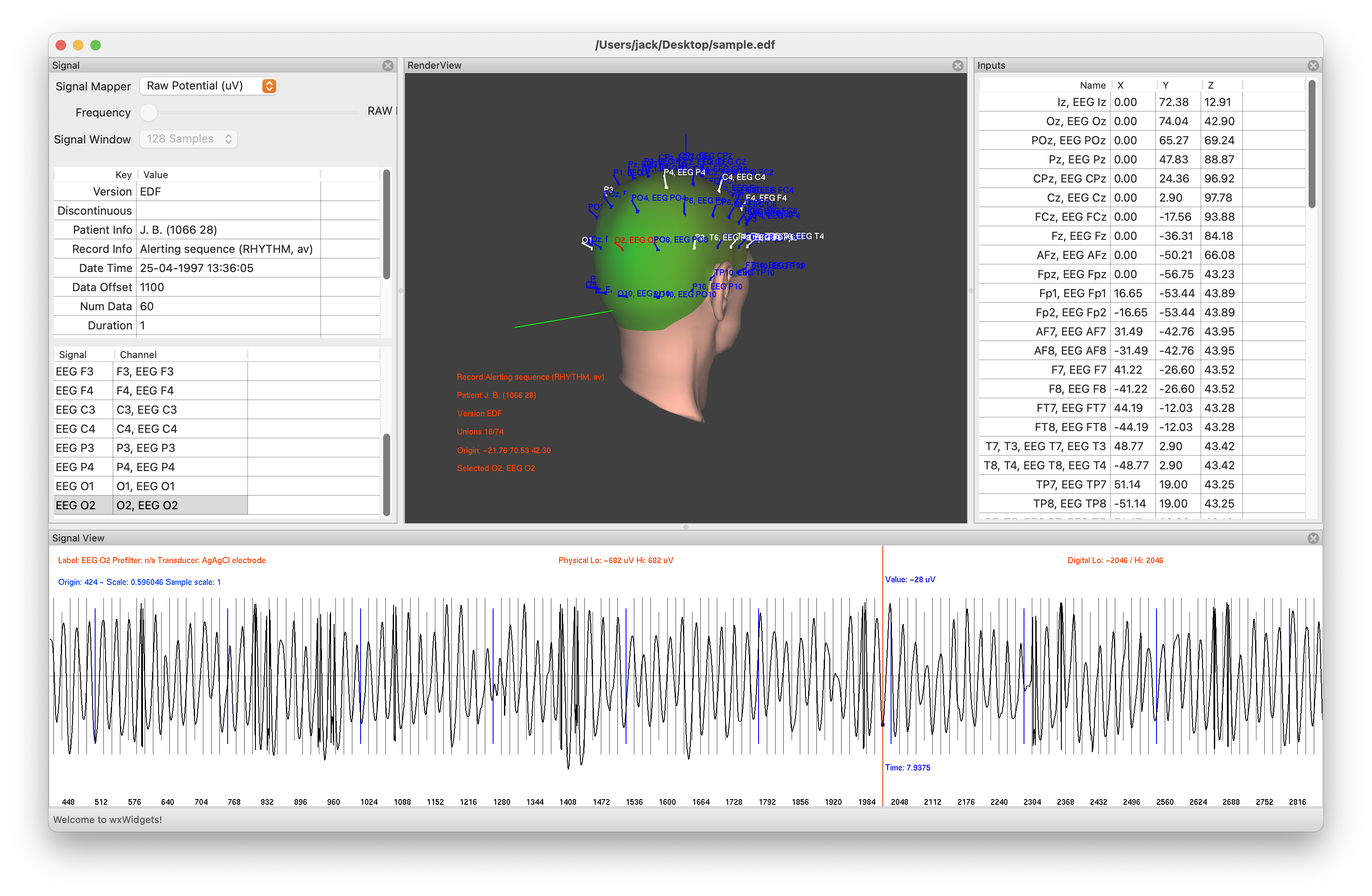 EEG Monitor